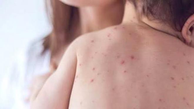 Health Measles-like symptoms leave three dead, suspected cases rise by 1,218