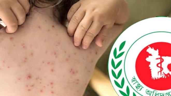Health Measles-like symptoms leave three dead, suspected cases rise by 1,218